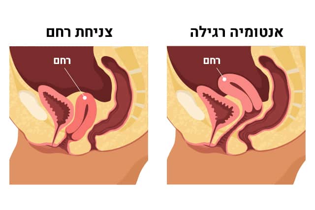 צניחת רחם 15 Prolapsus utérin Photo